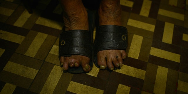 A Brazil man's feet show impacts of leprosy