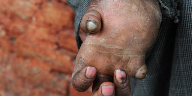 A leprosy patient holds out his hand in India