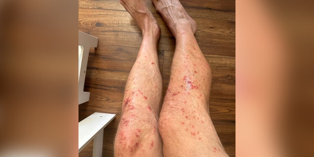 Man's legs covered in a rash