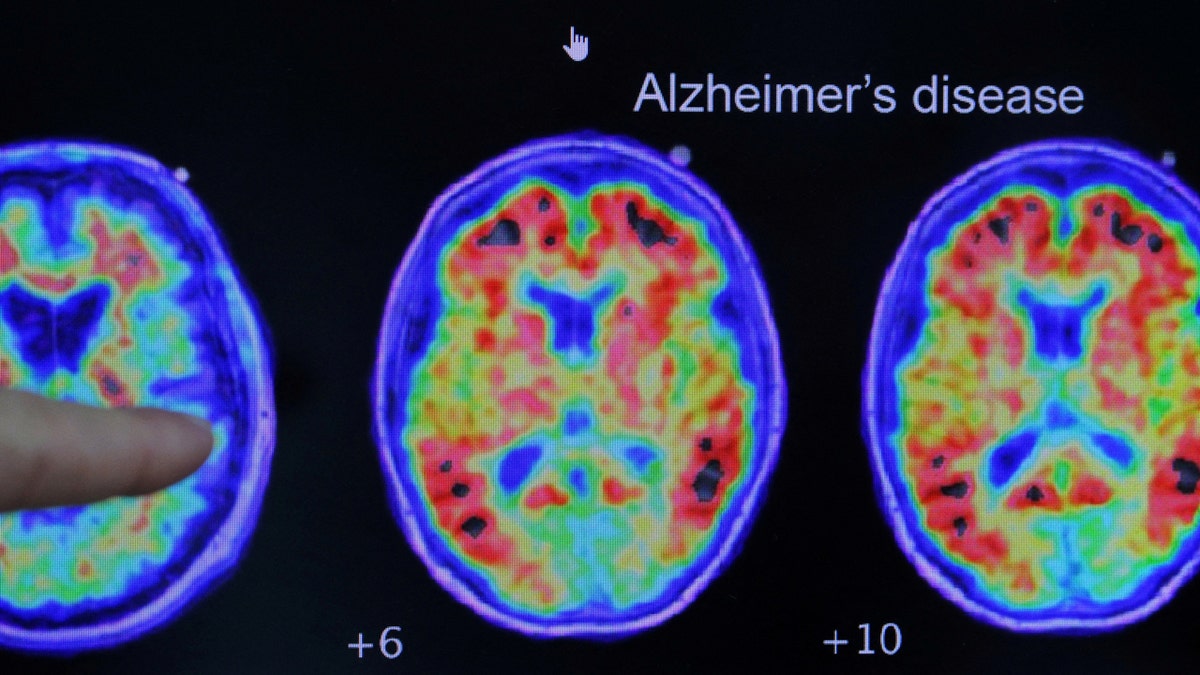 Alzheimer’s disease